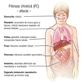 Fibroza chistică: semne, simptome și complicații - Sănătate - 